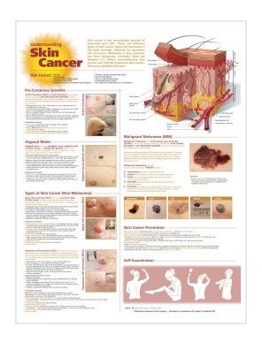 BODYLINE UNDERSTANDING SKIN CANCER CHART photo