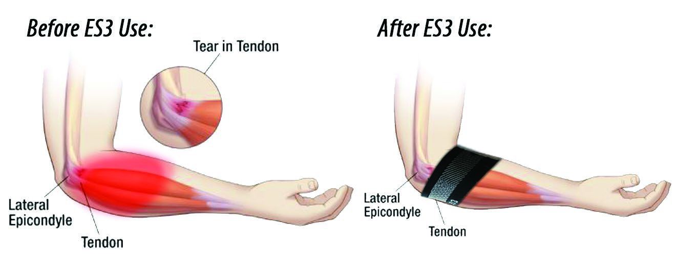 OS1 ELBOW SLEEVE / BLACK photo