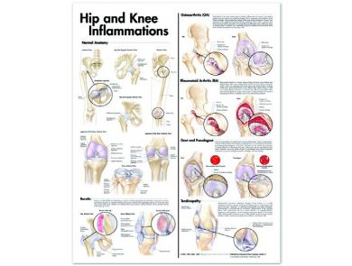 BODYLINE HIP & KNEE INFLAMMATIONS CHART - LAMINATED